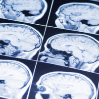 BrainInj3 BrainInj3