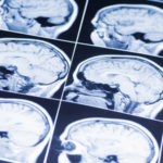 BrainInj3 BrainInj3