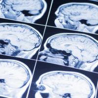 BrainInj3 BrainInj3