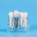 Dental_Implant Dental_Implant