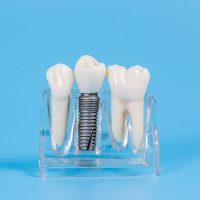 Dental_Implant Dental_Implant